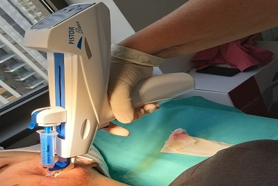 PRP-Behandlung der Schmierung mit eigenem Blutplasma